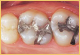 root canal image2