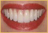 teeth bonding image2