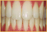 teeth whitening image2