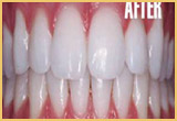 teeth whitening image