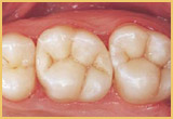 root canal image3