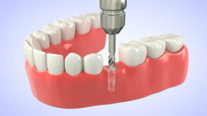 Dental Implants San Diego