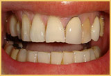 Porcelain Veneers Before