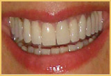 Porcelain Veneers After