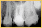 Root Canal