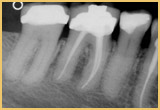 Root Canals