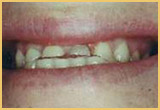 Porcelain Crowns Before