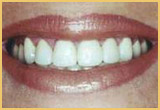 Porcelain Crowns After