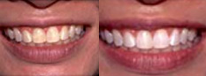 San Diego Dental Implants